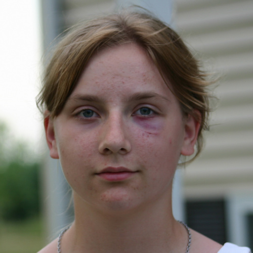black eye