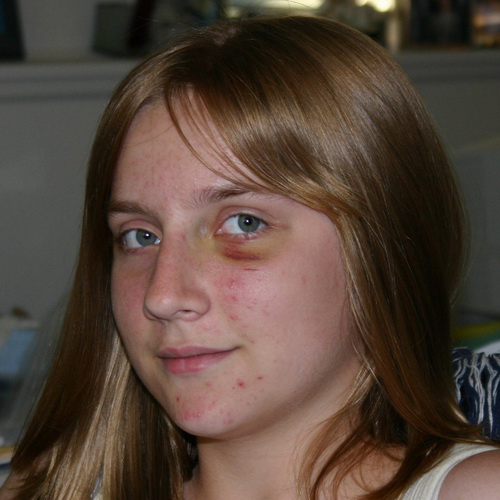 black eye